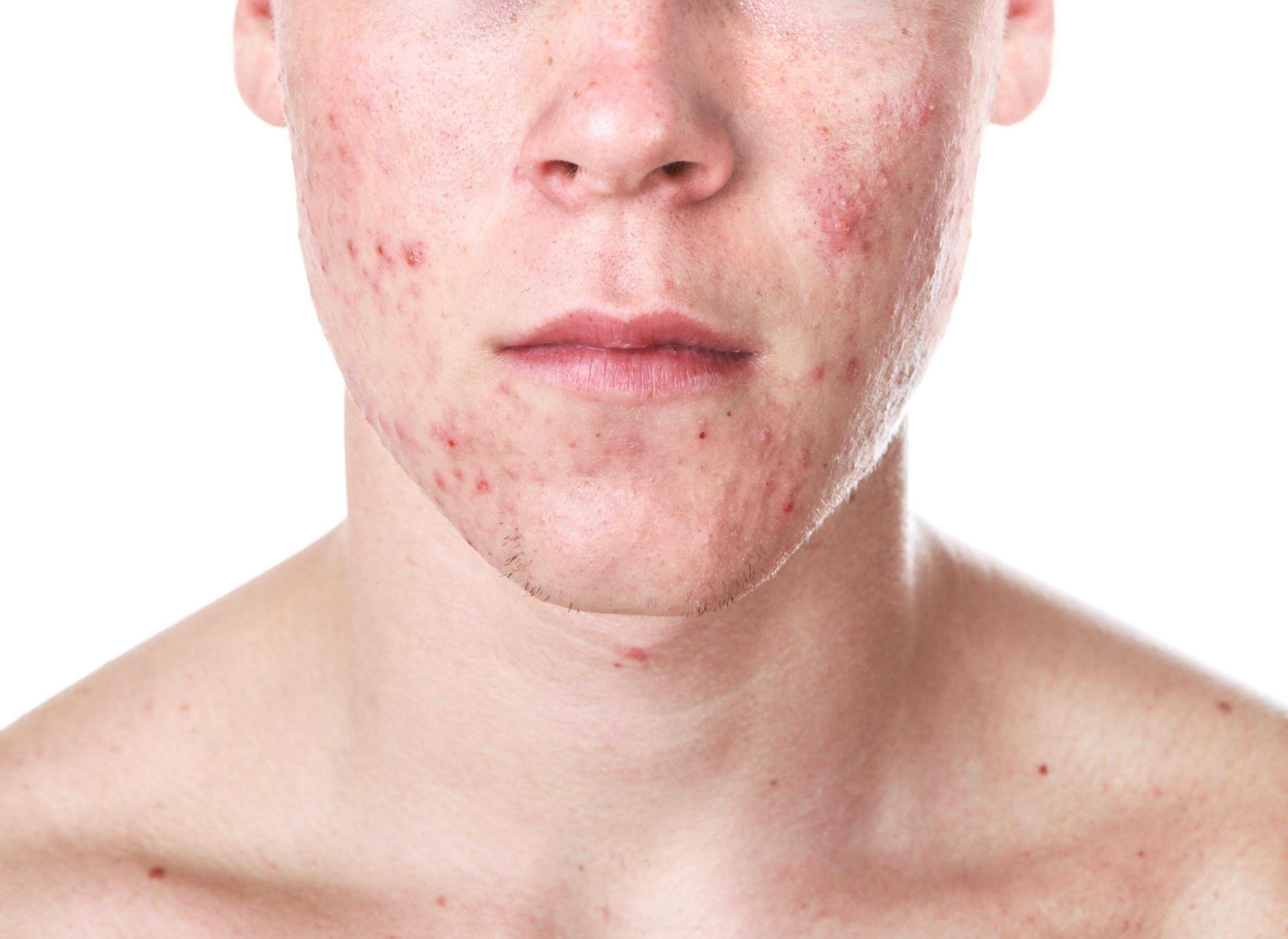 Acne bij tienerjongens